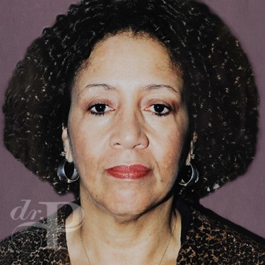Case--29858 | Before Facelift and Neck Lift 1