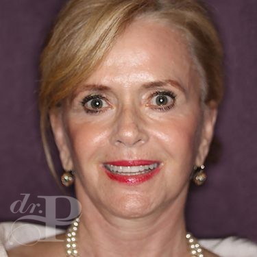 Case--28075 | After Facelift and Neck Lift 1