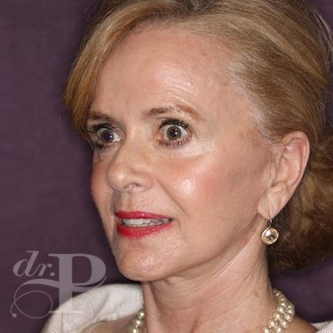 Case--28075 | After Facelift and Neck Lift 2