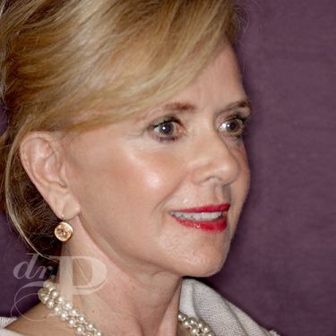 Case--28075 | After Facelift and Neck Lift 4