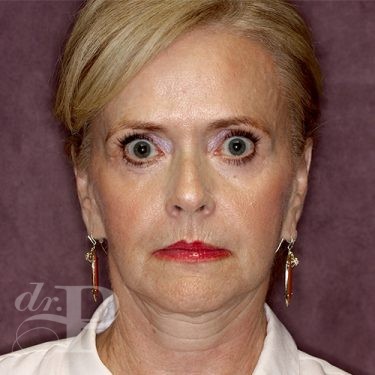 Case--28075 | Before Facelift and Neck Lift 1