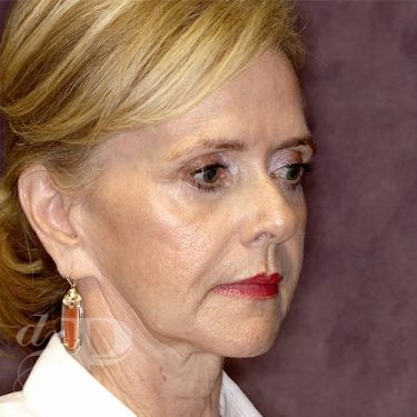 Case--28075 | Before Facelift and Neck Lift 4