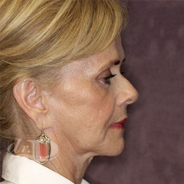 Case--28075 | Before Facelift and Neck Lift 5