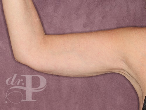 Case--28322 | After Arm Lift 1