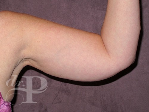 Case--28322 | Before Arm Lift 2