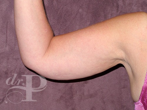 Case--28322 | Before Arm Lift 1