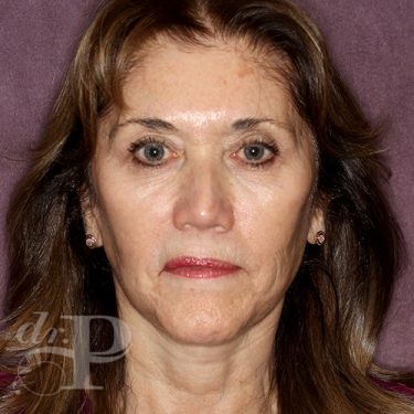 Case--28171 | After Facelift and Neck Lift 1