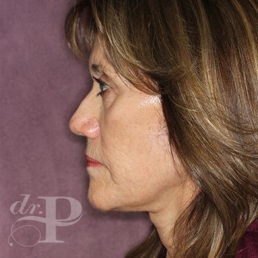Case--28171 | After Facelift and Neck Lift 3
