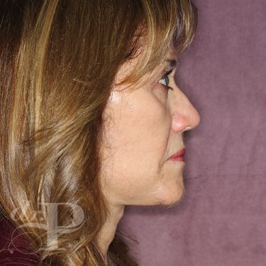 Case--28171 | After Facelift and Neck Lift 5