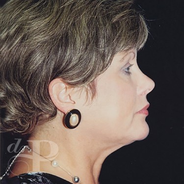Case--30129 | After Facelift and Neck Lift 5