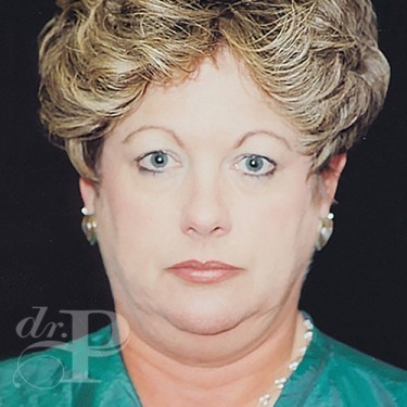 Case--30129 | Before Facelift and Neck Lift 1