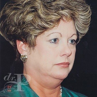 Case--30129 | Before Facelift and Neck Lift 4