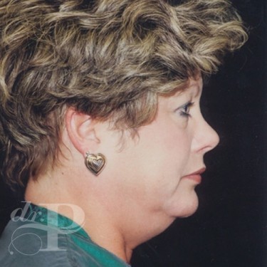 Case--30129 | Before Facelift and Neck Lift 5