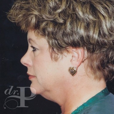 Case--30129 | Before Facelift and Neck Lift 3