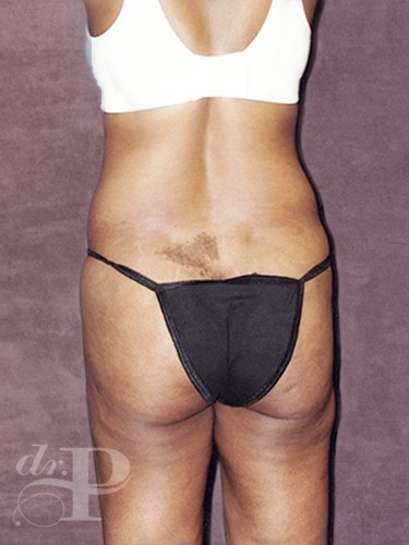 Case--30191 | Before Tummy Tuck - Corrective/Revision 4