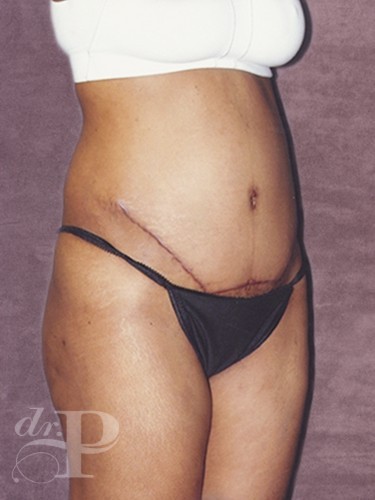 Case--30191 | Before Tummy Tuck - Corrective/Revision 2