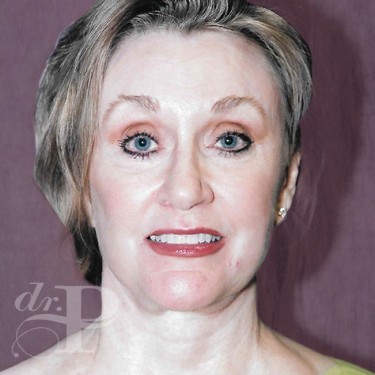 Case--30059 | After Brow Lift 1