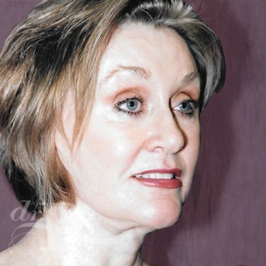 Case--30074 | After Facelift and Neck Lift 3