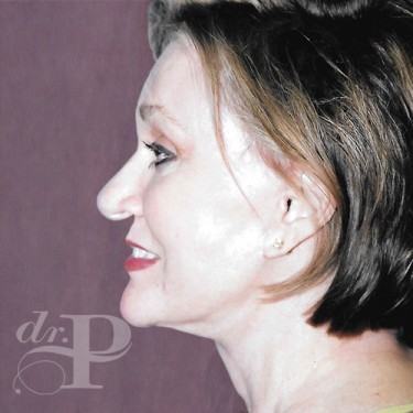 Case--30071 | After Eyelid Surgery (Blepharoplasty) 2