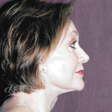 Case--30071 | After Eyelid Surgery (Blepharoplasty) 4