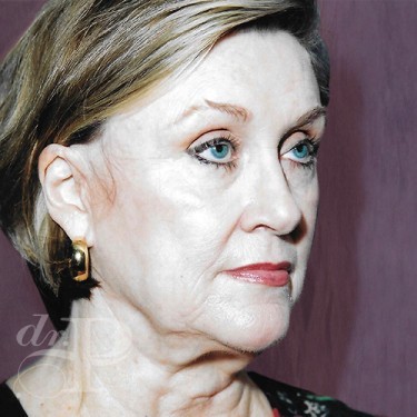 Case--30059 | Before Brow Lift 3