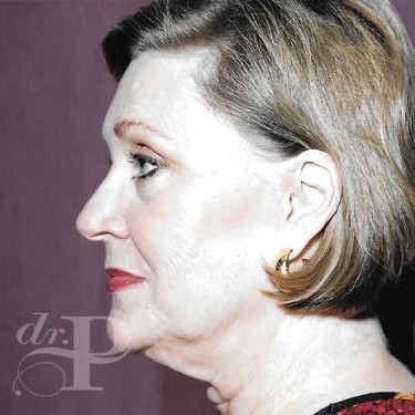 Case--30074 | Before Facelift and Neck Lift 2