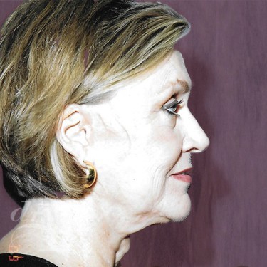 Case--30059 | Before Brow Lift 4