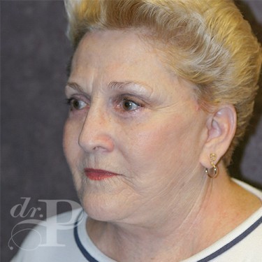 Case--29885 | After Nose Surgery (Rhinoplasty) 2