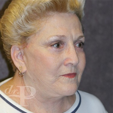 Case--29882 | After Facelift and Neck Lift 4