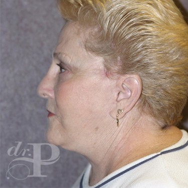 Case--29882 | After Facelift and Neck Lift 3