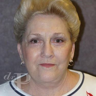 Case--29885 | After Nose Surgery (Rhinoplasty) 1