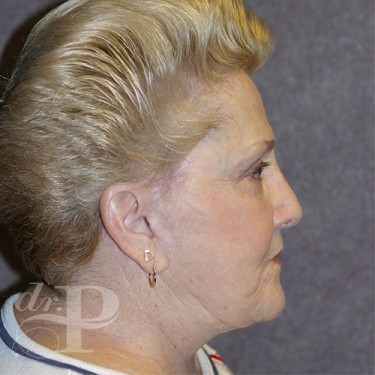 Case--29882 | After Facelift and Neck Lift 5