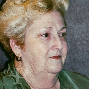 Case--29882 | Before Facelift and Neck Lift 4