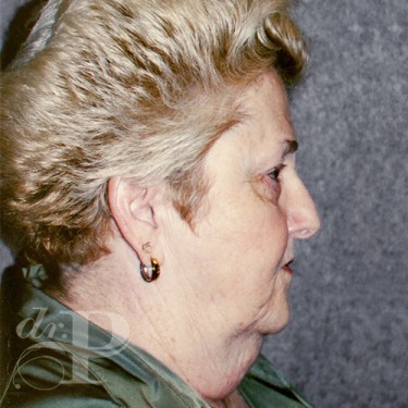 Case--29863 | Before Eyelid Surgery (Blepharoplasty) 5