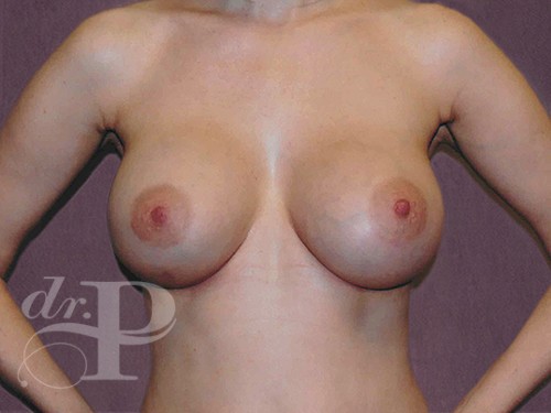 Case--29491 | After Corrective/Revision Breast Implant Surgery 1