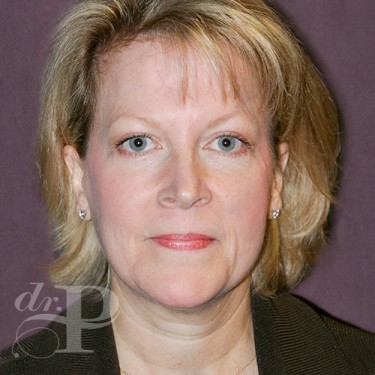 Case--29762 | After Eyelid Surgery (Blepharoplasty) 1