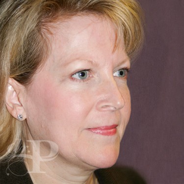Case--29762 | After Eyelid Surgery (Blepharoplasty) 4