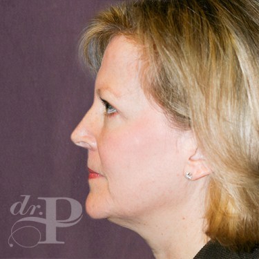 Case--29762 | After Eyelid Surgery (Blepharoplasty) 3