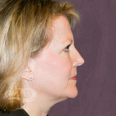 Case--29762 | After Eyelid Surgery (Blepharoplasty) 5