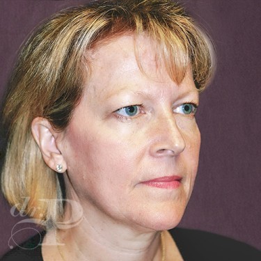 Case--29762 | Before Eyelid Surgery (Blepharoplasty) 4