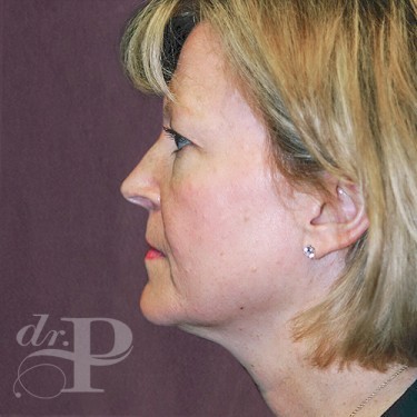 Case--29762 | Before Eyelid Surgery (Blepharoplasty) 3