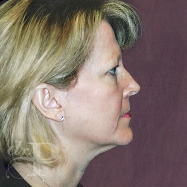 Case--29762 | Before Eyelid Surgery (Blepharoplasty) 5