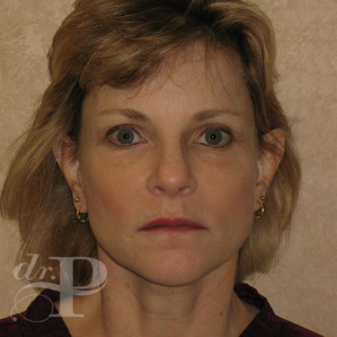Case--30246 | After Facelift and Neck Lift 1