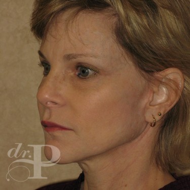 Case--30233 | After Eyelid Surgery (Blepharoplasty) 2