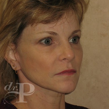 Case--30246 | After Facelift and Neck Lift 4