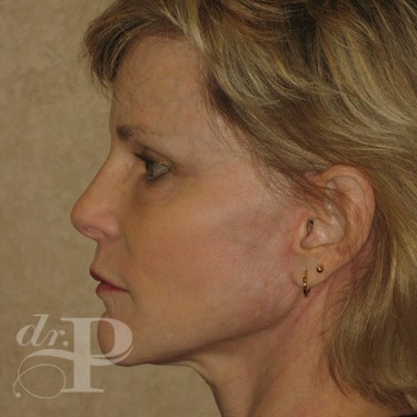 Case--30246 | After Facelift and Neck Lift 3