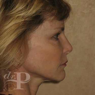 Case--30246 | After Facelift and Neck Lift 5