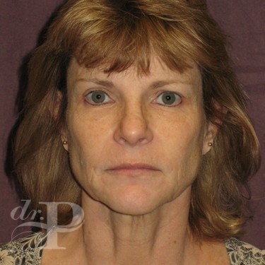 Case--30246 | Before Facelift and Neck Lift 1