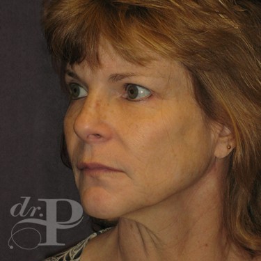 Case--30246 | Before Facelift and Neck Lift 2