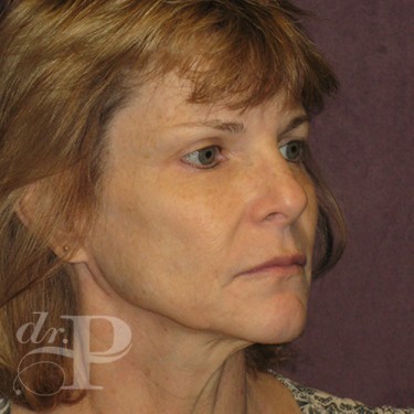 Case--30246 | Before Facelift and Neck Lift 4